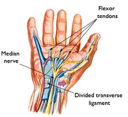 Vipal Dua, MD: Carpal Tunnel Syndrome - Providing Elbow, Mako Robotic ...