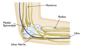 Vipal Dua, MD: Ulnar Nerve Entrapment at the Elbow (Cubital Tunnel ...