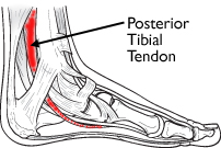 Vipal Dua, MD: Adult Acquired Flatfoot - Providing Elbow, Orthopedic ...