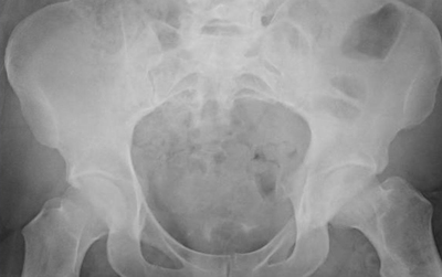 Vipal Dua, MD: Hip Dislocation - Providing General Orthopedics, Ankle ...